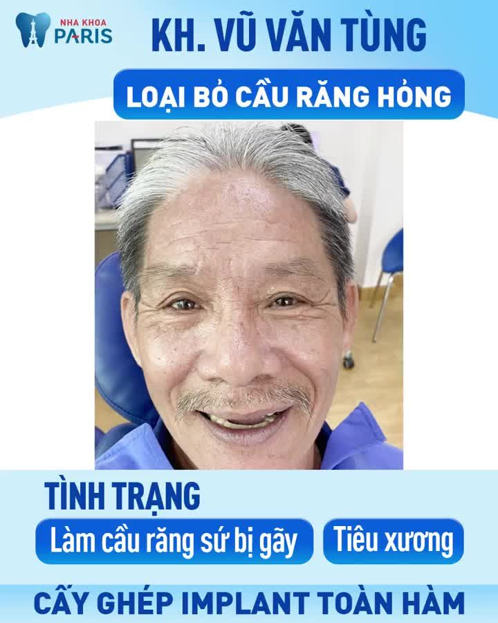 CÓ NÊN TRỒNG IMPLANT TOÀN HÀM THAY CẦU RĂNG?